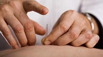 5 Surprising Health Benefits of Acupuncture