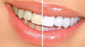 Keeping Your Teeth Pearly White: Your Guide to Preventing Teeth Stains