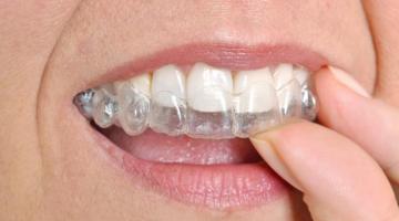 How Do You Clean a Retainer? Tips and Tricks to Keep It Fresh